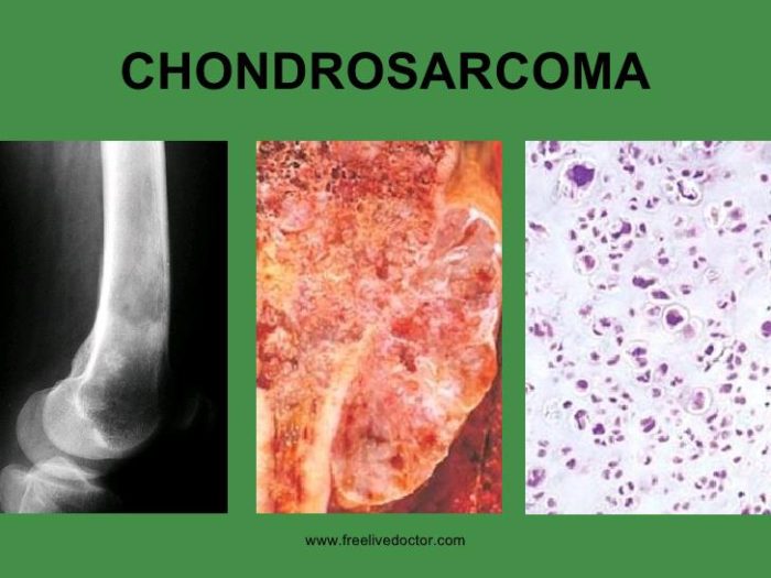 Chondrosarcoma  