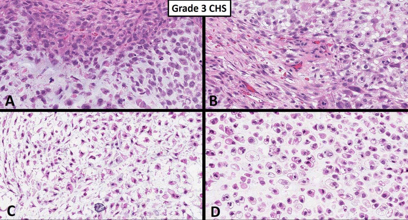 Chondrosarcoma Challenges In Diagnosis Grading And The Importance Of Proper Classification 7924